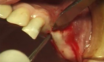 Применение фосфатов кальция в составах стоматологических материалов